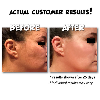 Before and after skin treatment results using hyaluronic acid on a customer's face with text indicating results after 25 days.