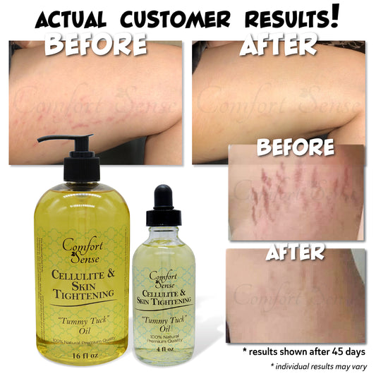 Cellulite & Skin Tightening “Tummy Tuck” Oil