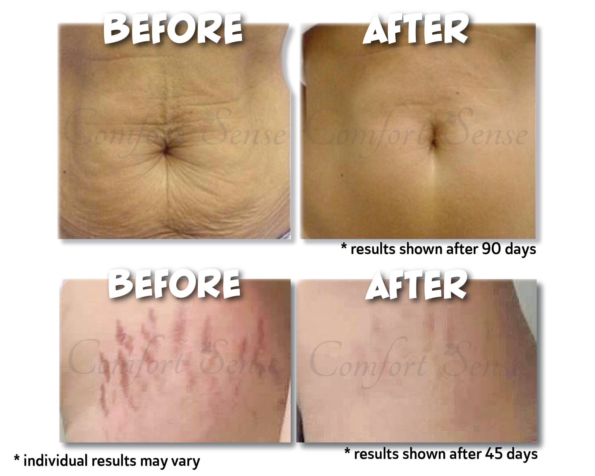 Tighten Skin and Reduce Cellulite, Wrinkles, and Circumferential